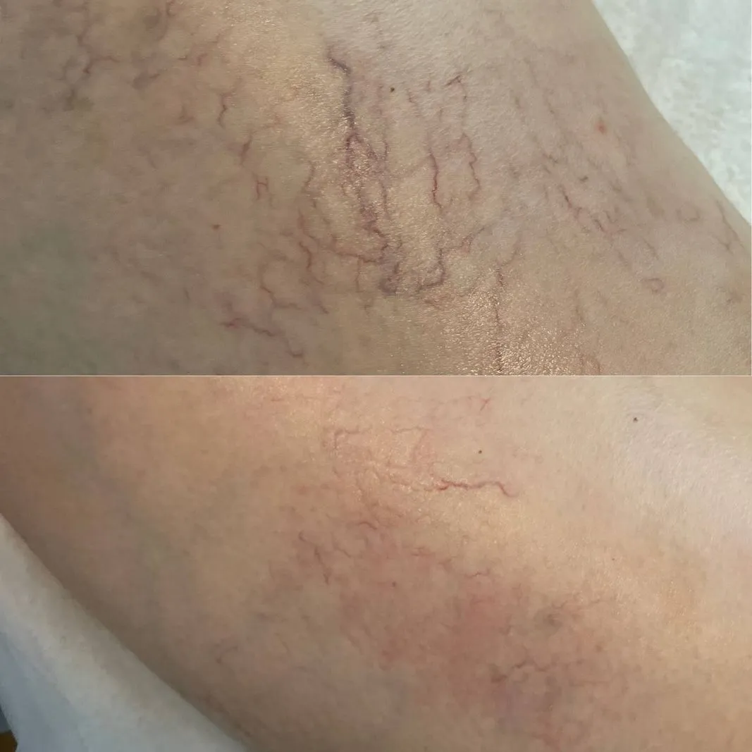 Сосудистая сетка на ноге до и после 6 процедур Endospheres Therapy