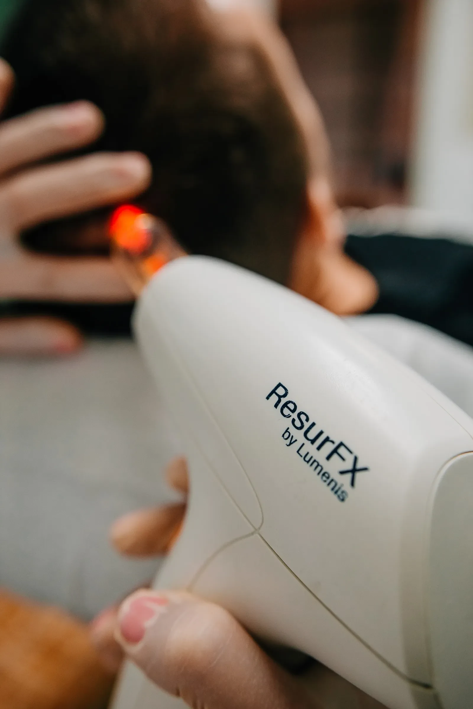 Стимуляция роста волос Lumenis M22