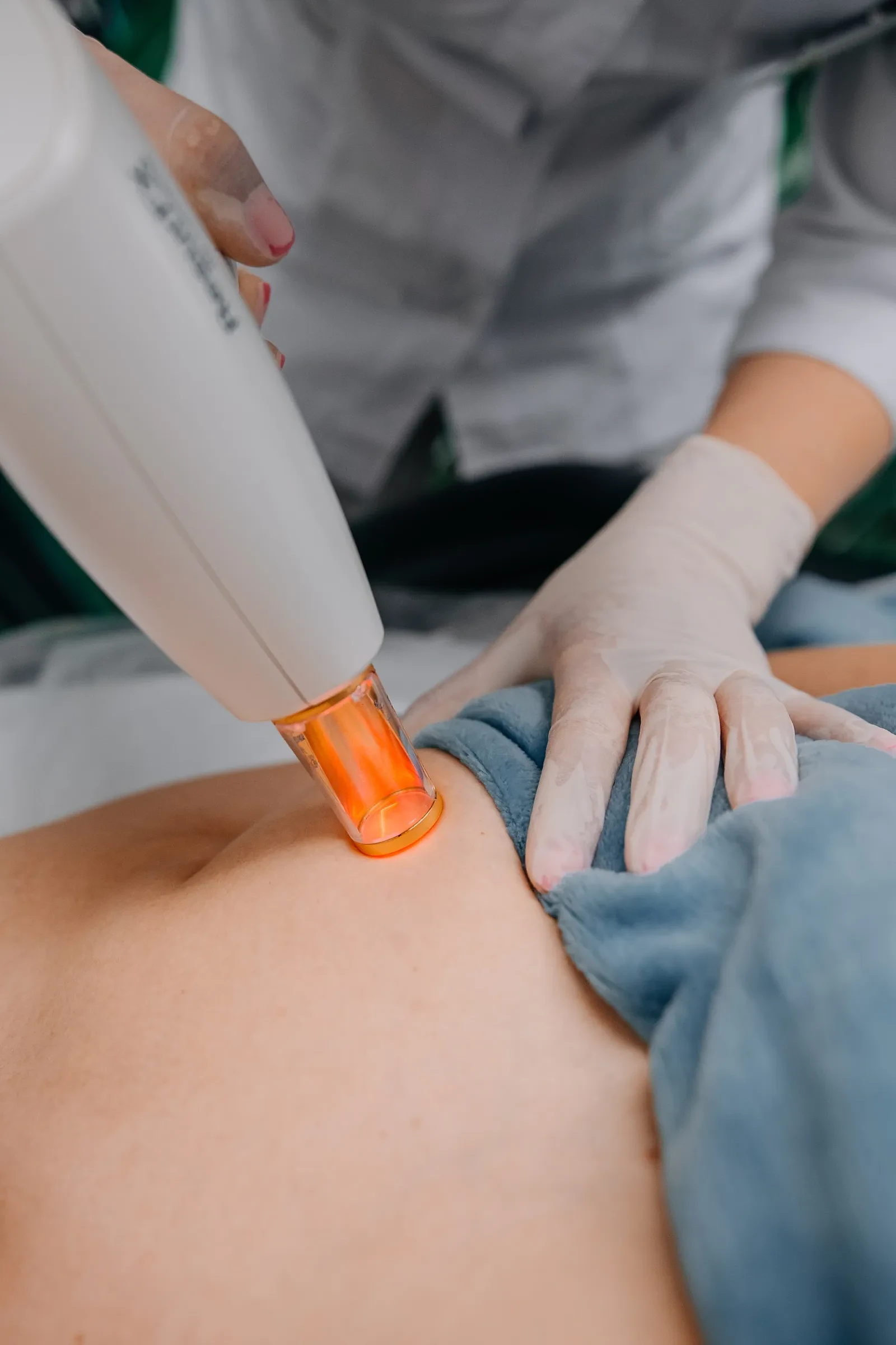 Видалення розтяжок Lumenis M22