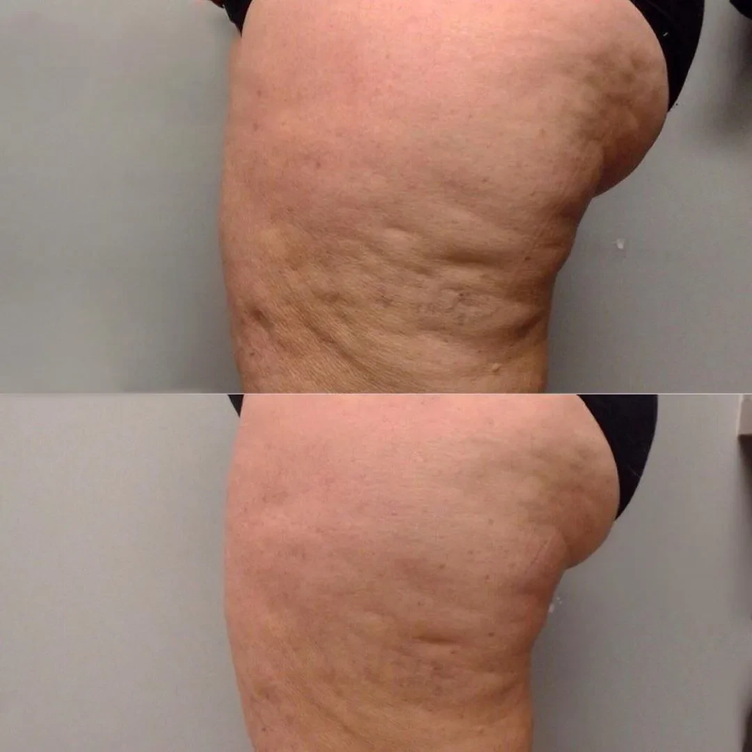 Результат после Endospheres Therapy