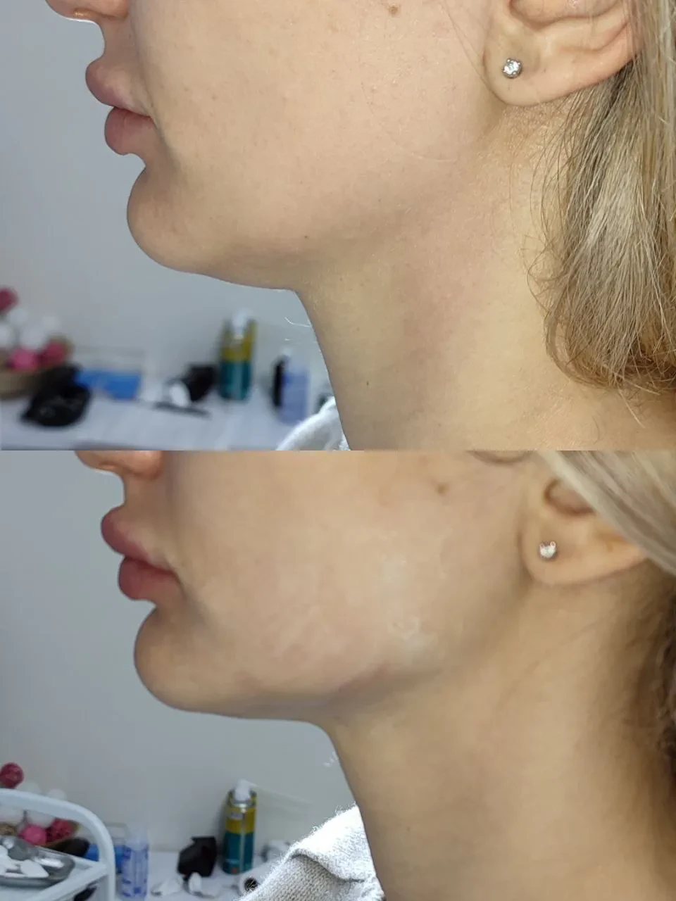 SMAS лифтинг лица